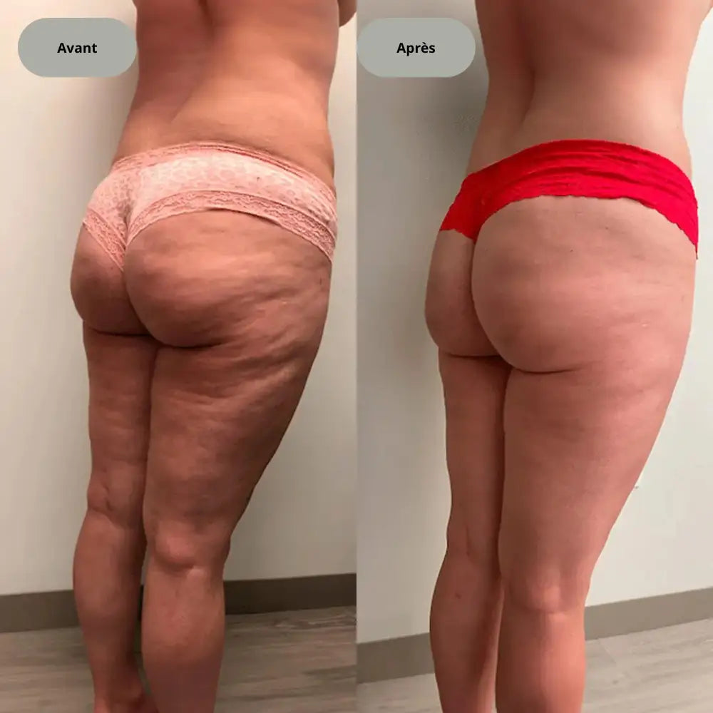Appareil anti-cellulite