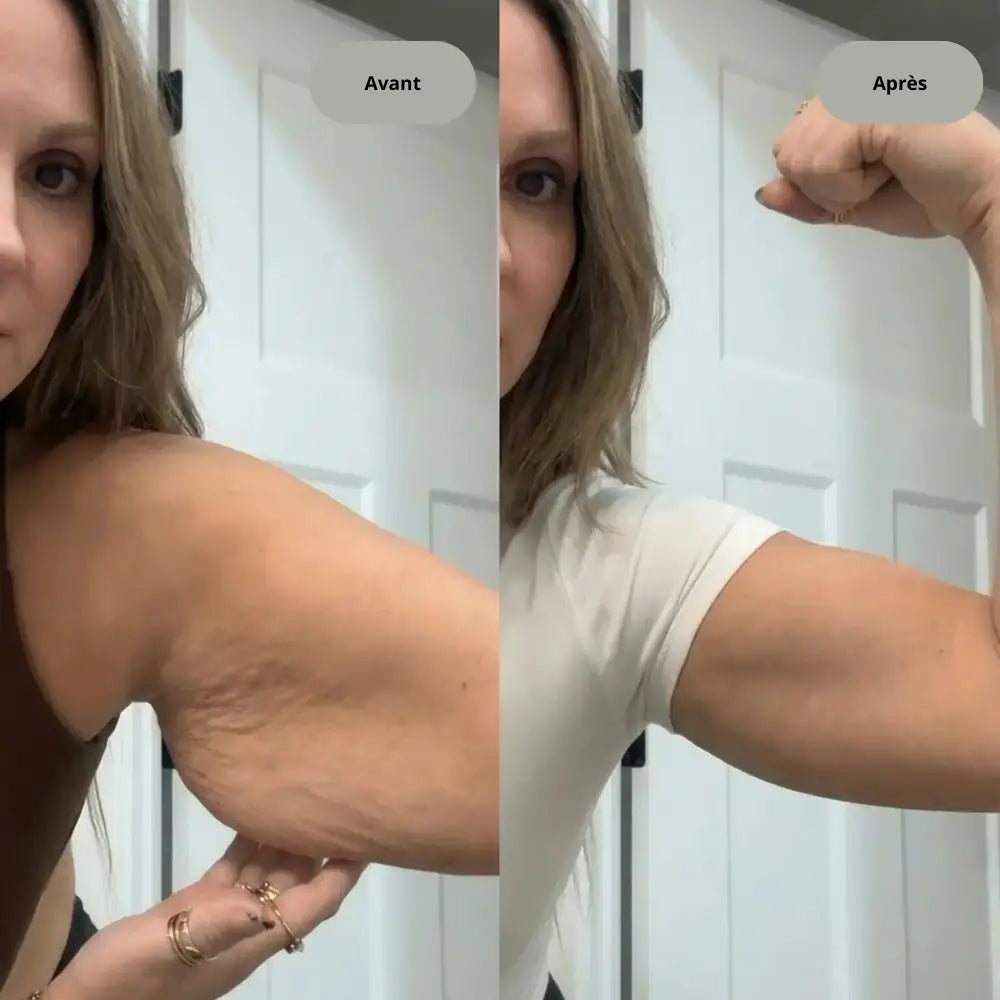 Appareil anti-cellulite