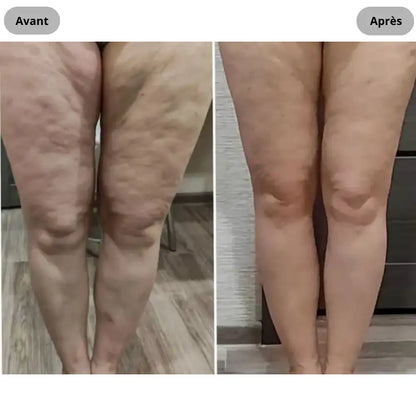 Appareil anti-cellulite